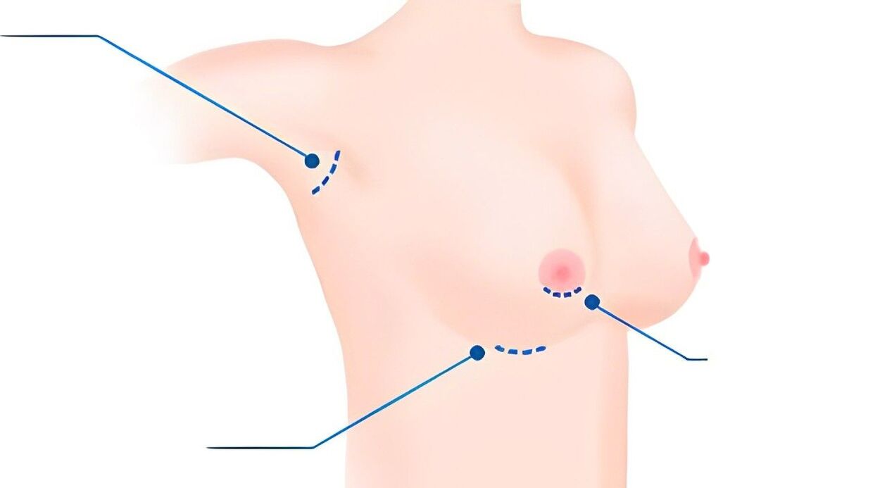 Tipos de tallas para a ampliación do peito